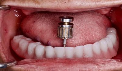 ¿Cómo sé cuándo necesito Implantes Dentales All-On-X , Arco Completo ?