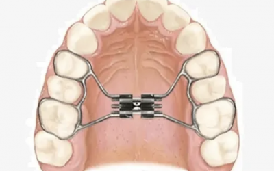 Expansor Palatino: qué es, para qué sirve y cuándo se recomienda