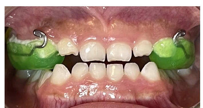 beneficios-de-la-ortopedia-maxilar-oralmaxq
