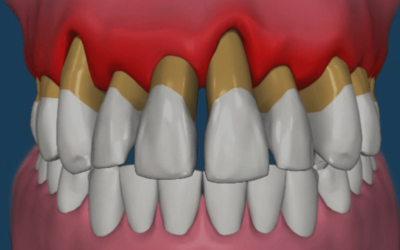 Periodontitis: causas, síntomas y tratamiento para mantener una sonrisa saludable