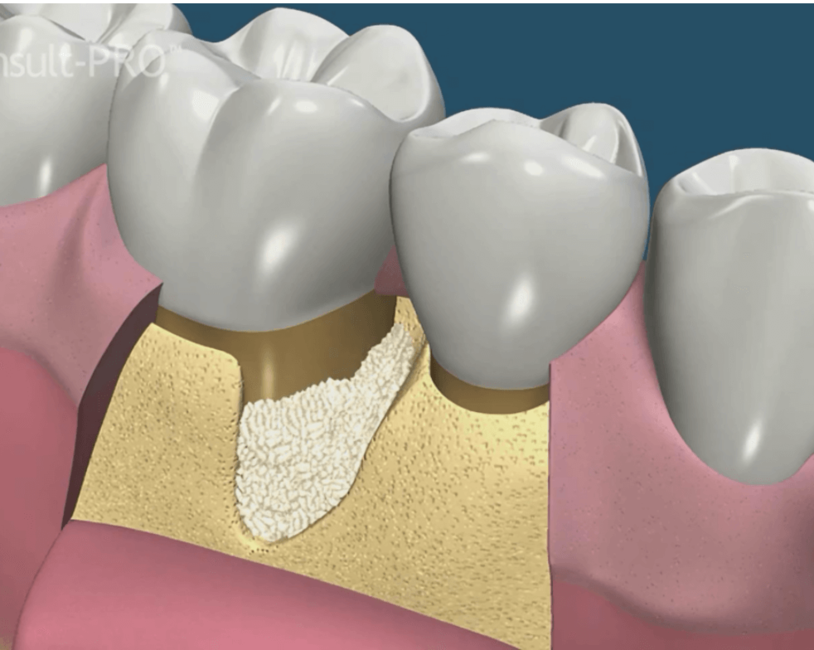 tratamiento-para-la-periodontitis-clinica-oralmaxq