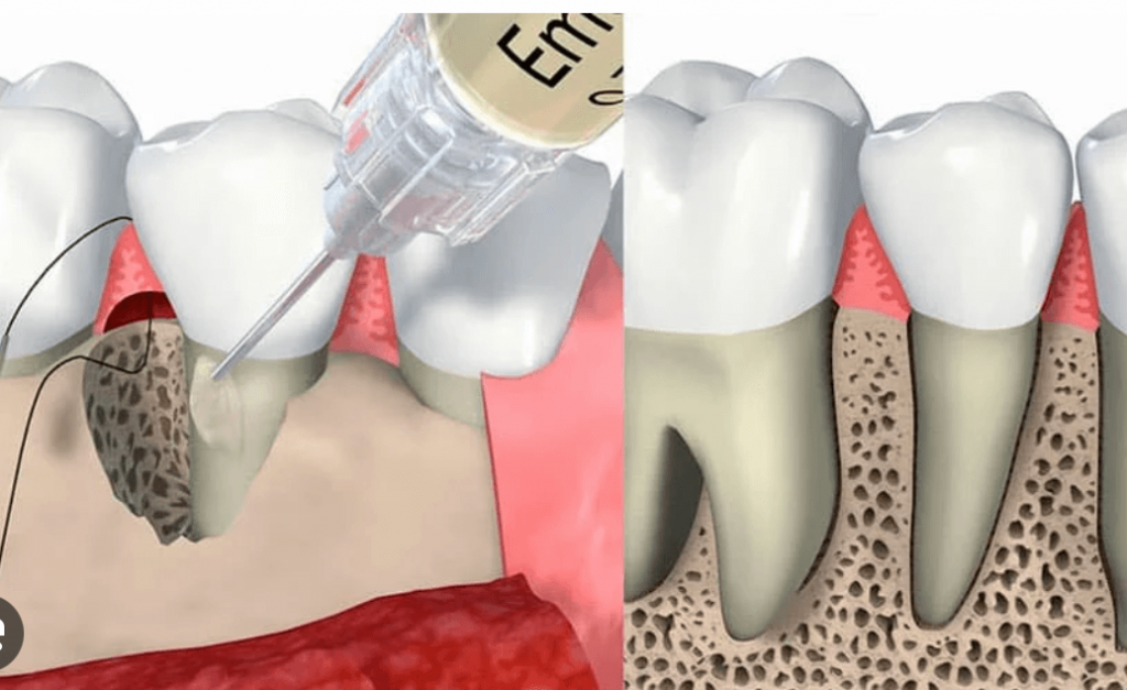 tratamiento-para-la-periodontitis1-clinica-oralmaxq