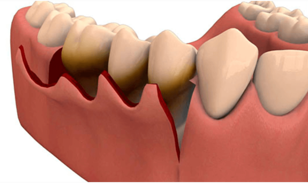 tratamiento-para-la-periodontitis2-clinica-oralmaxq