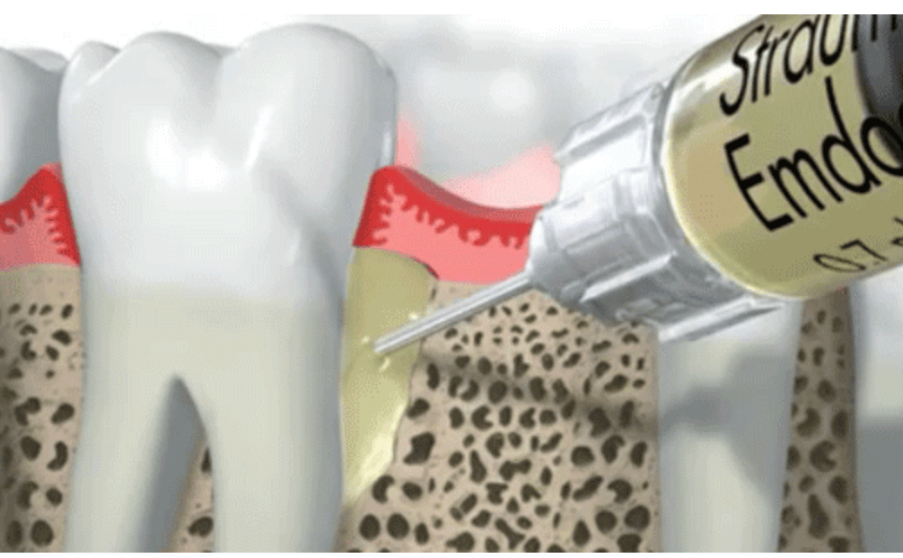 tratamiento-para-la-periodontitis3-clinica-oralmaxq