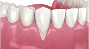 beneficios-de-la-periodoncia-clinica-oralmaxq