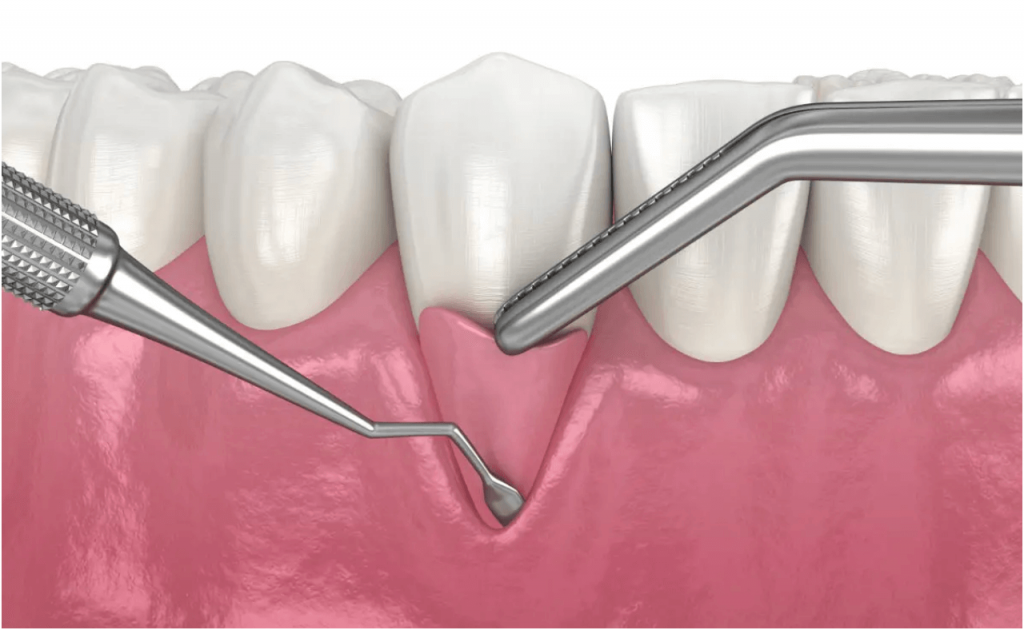ventajas-de-la-periodoncia-clinica-oralmaxq