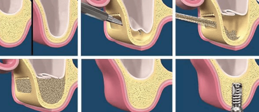 area-afectada-cirugia-periodontal-clinica-oralmaxq