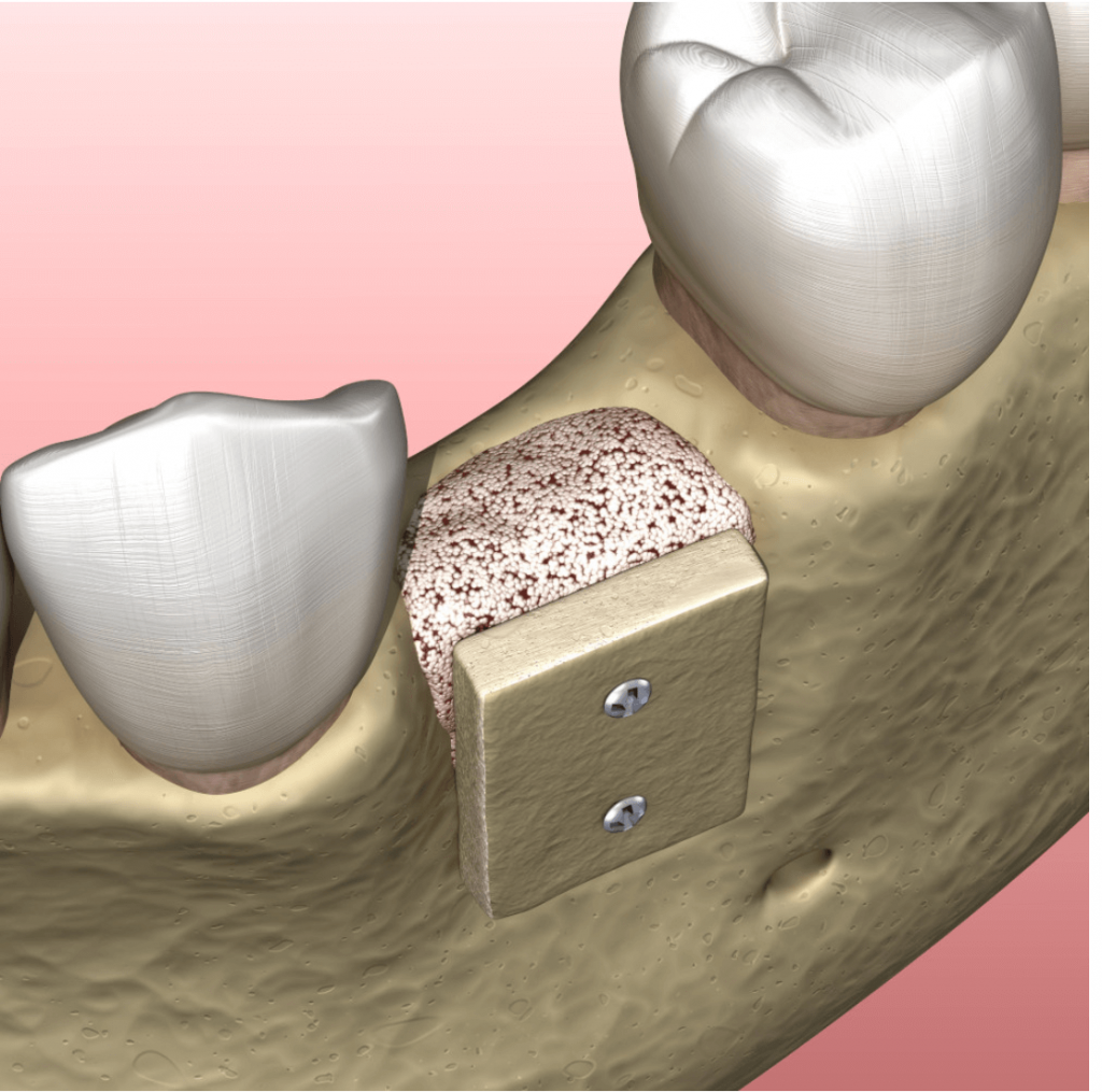 beneficios-injerto-oseo-dental-clinica-oralmaxq