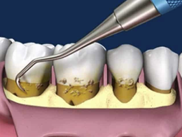 beneficios-limpieza-dental-profunda-clinica-oralmaxq