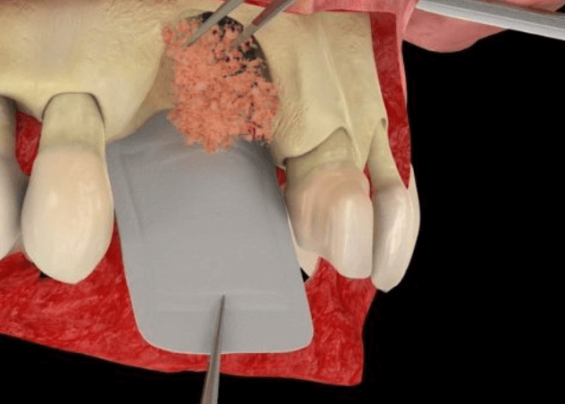 colocacion-injerto-oseo-clinica-oralmaxq