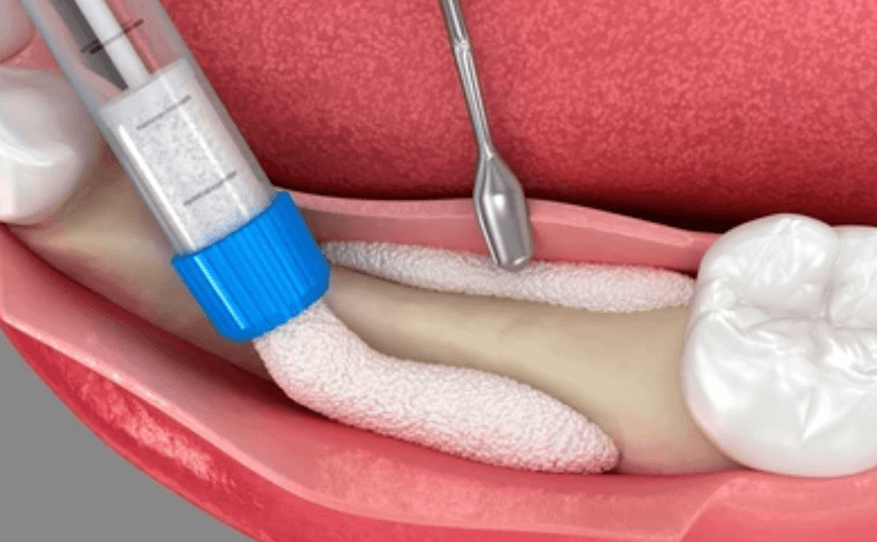 control-y-mantenimiento-periodontal-clinica-oralmaxq