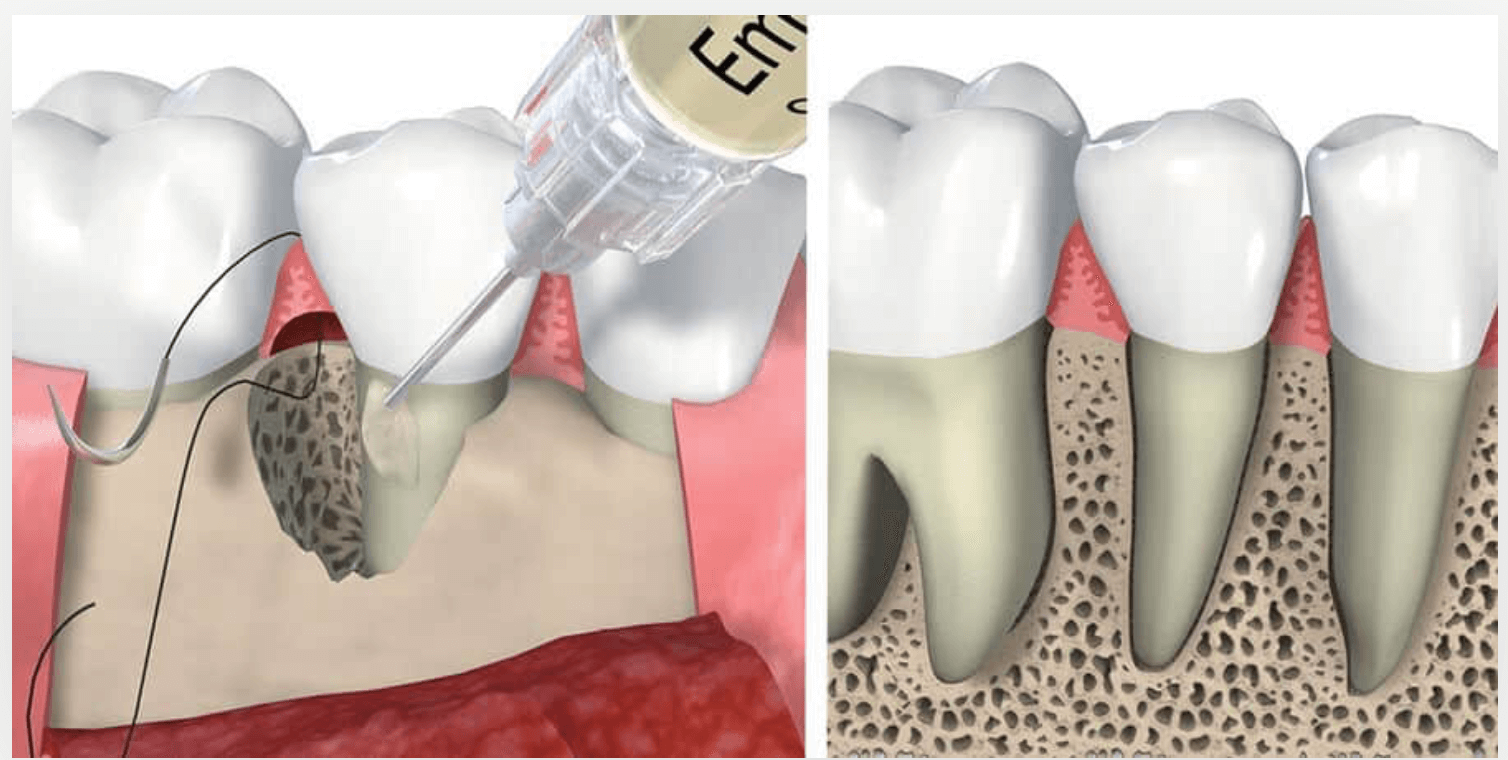 injerto-oseo-periodontal-clinica-oralmaxq