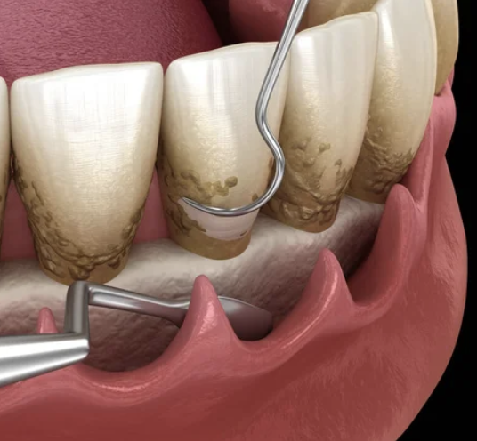 limpieza-dental-profuna-clinica-oralmaxq