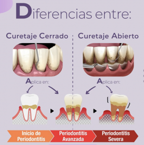 mantenimiento-periodontal-clinica-oralmaxq