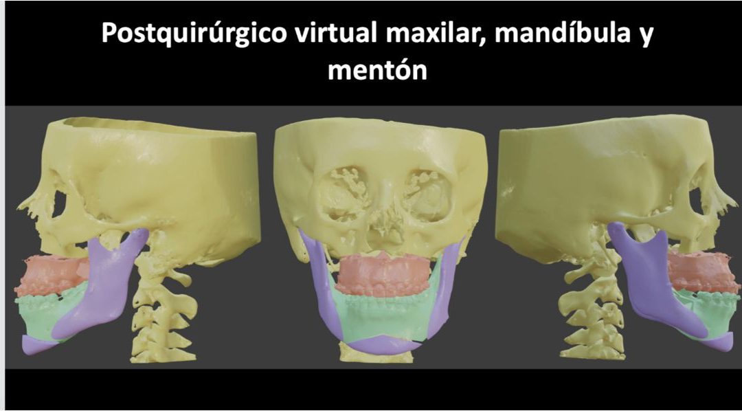 Cirugía ortognática: qué es y cuándo se indica
