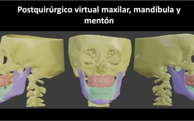  Cirugía ortognática: qué es y cuándo se indica