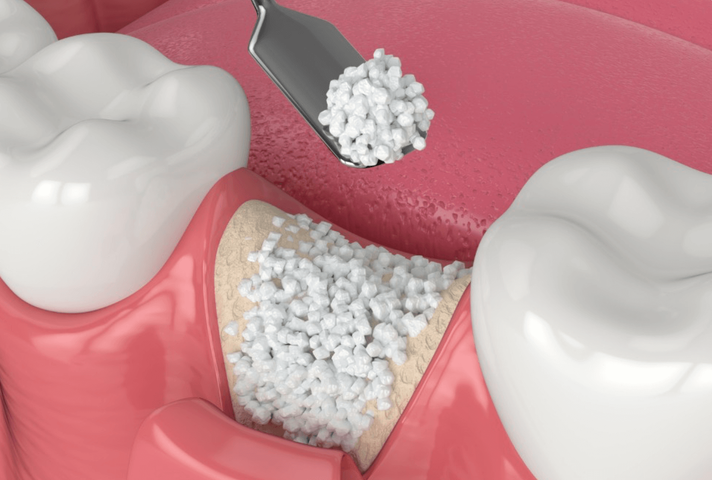 recomendacion-regeneracion-osea-periodontal-clinica-oralmaxq