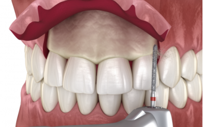 Tipos de cirugía periodontal: procedimientos y cuidados