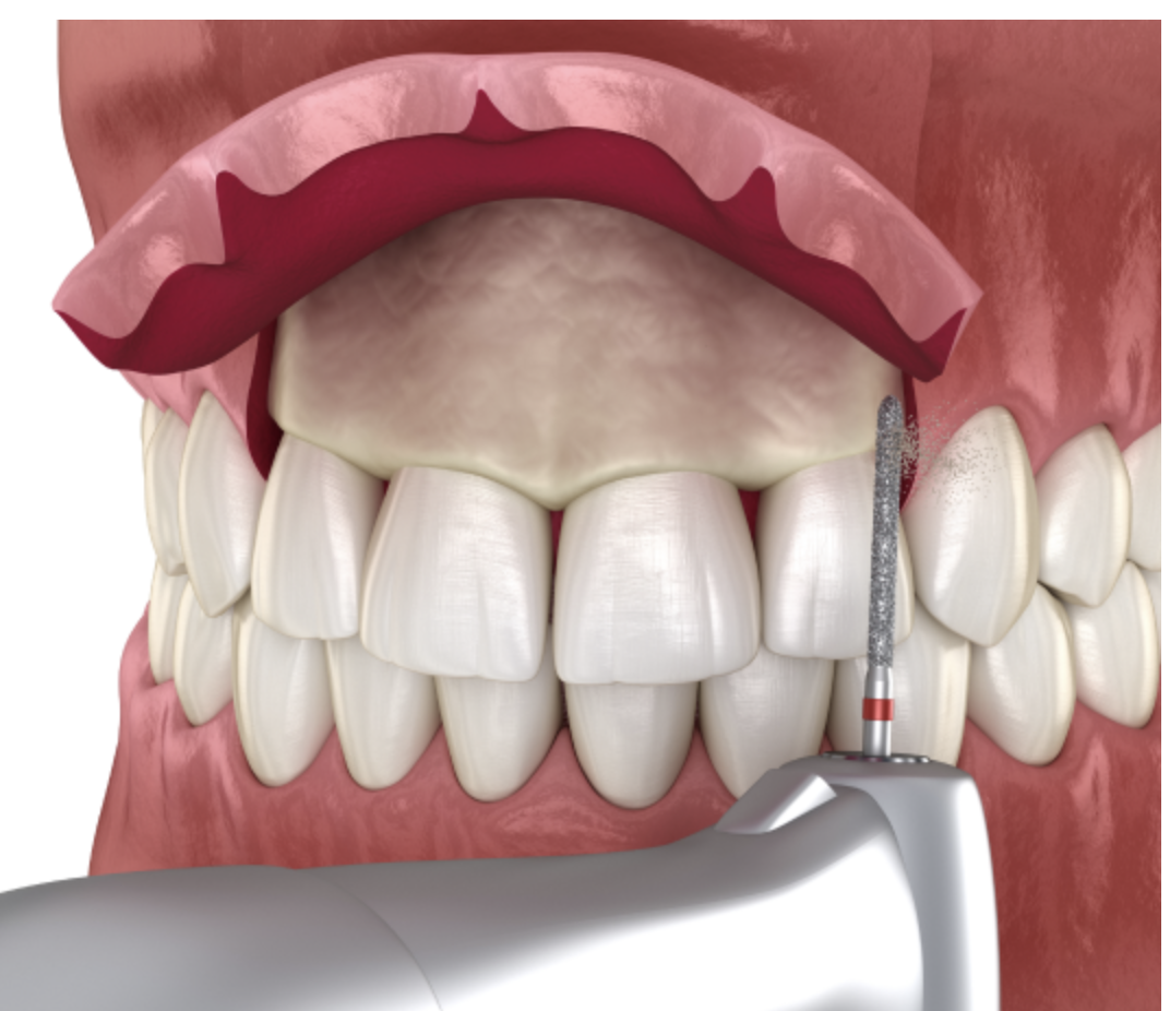 injerto-oseo-periodontal-clinica-oralmaxq