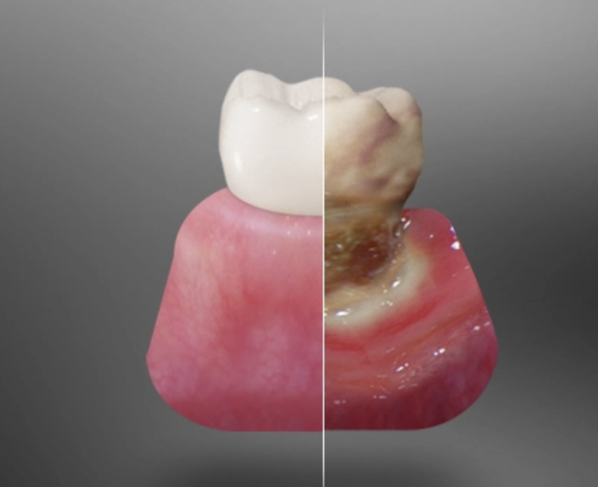 beneficios-injerto-oseo-dental-clinica-oralmaxq