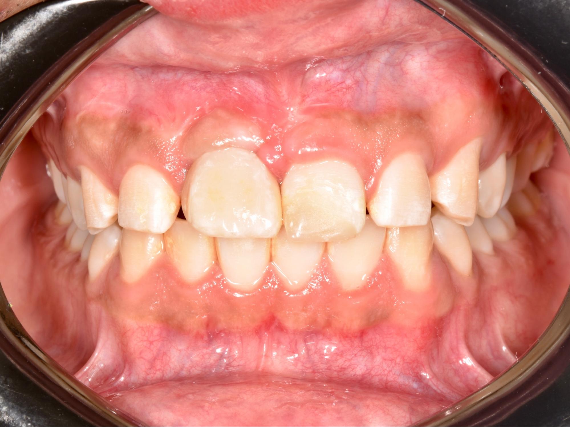 beneficios-de-tratar-una-fractura-dental-a-tiempo-clinica-oralmaxq
