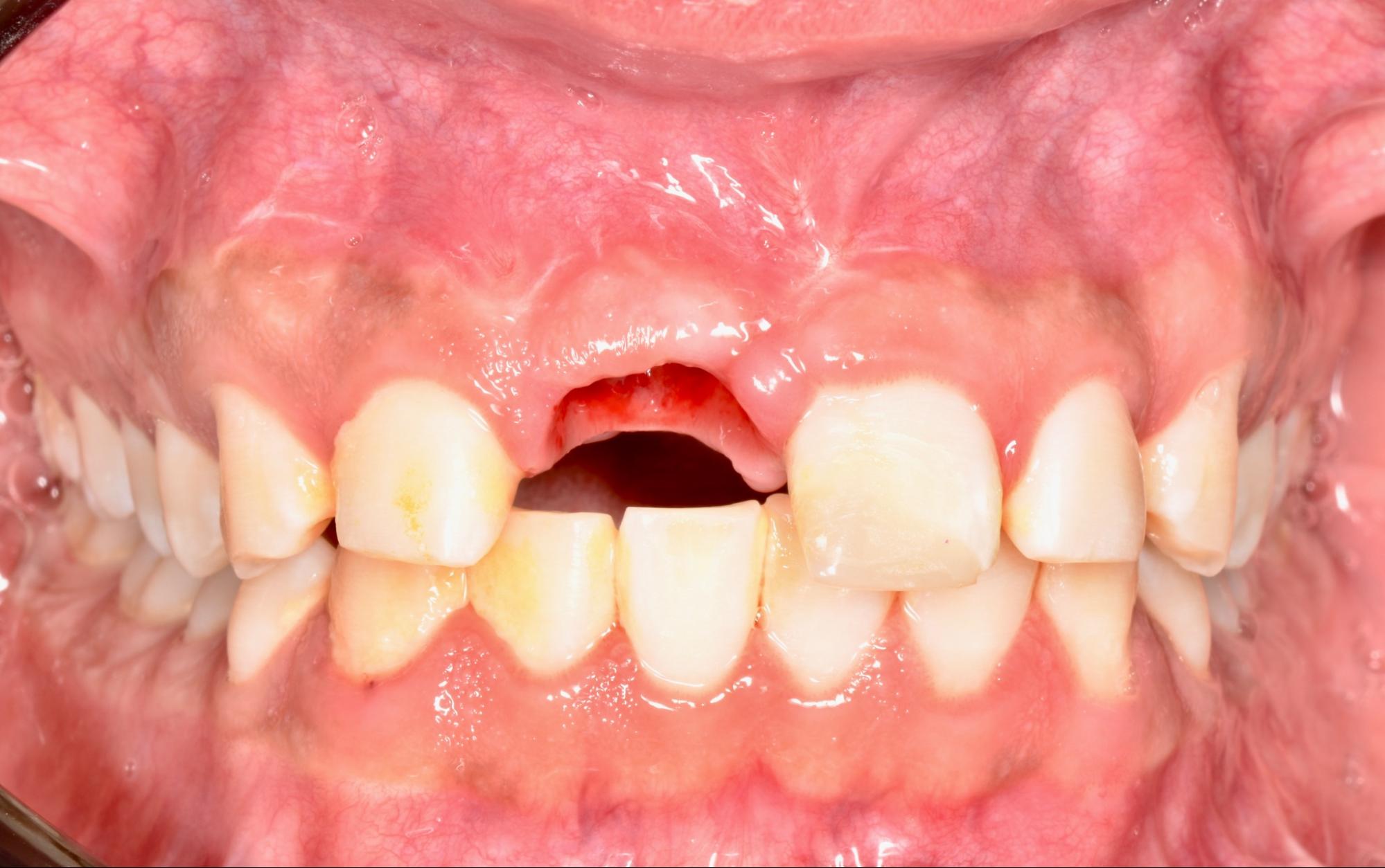 beneficios-de-tratar-una-fractura-dental-a-tiempo-oralmaxq
