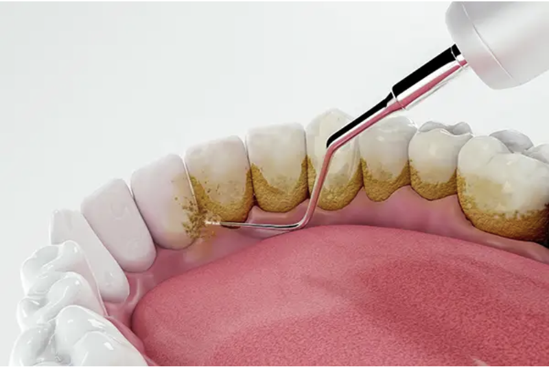beneficios-injerto-oseo-dental-clinica-oralmaxq