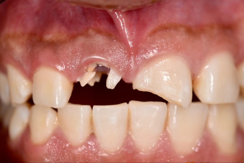 fracturas-dentales-en-queretaro-clinica-oralmaxq