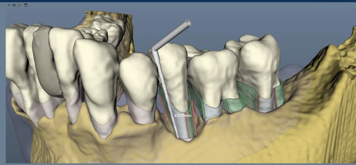 injerto-oseo-periodontal-clinica-oralmaxq