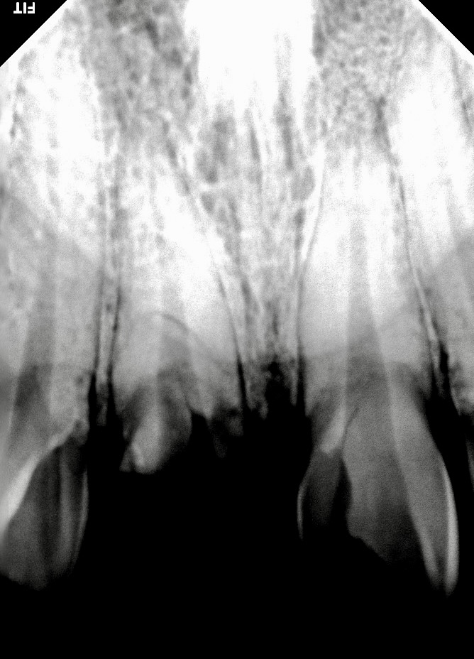 que-es-una-fractura-dental-clinica-oralmaxq