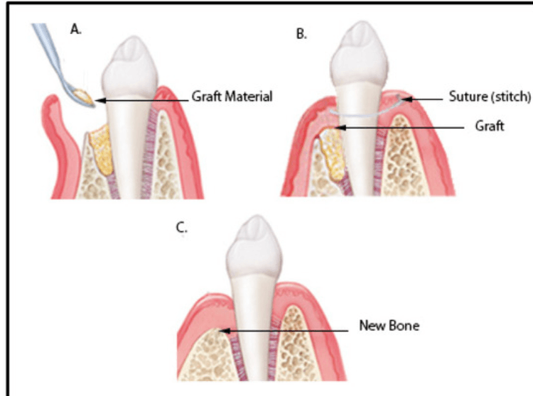 Injerto óseo periodontal - Clinica Oralmaxq