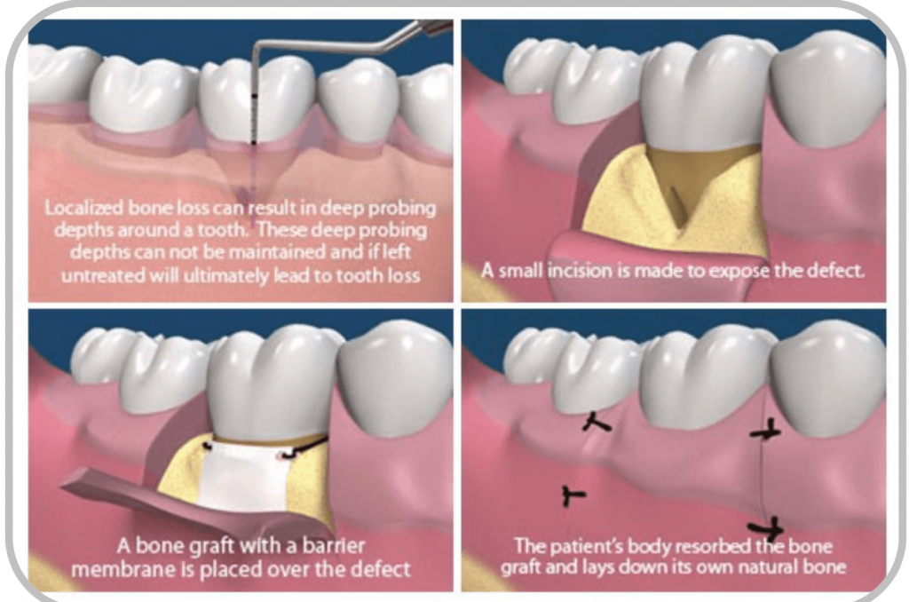 Principales técnicas de regeneración ósea periodontal - Clinica Oralmaxq