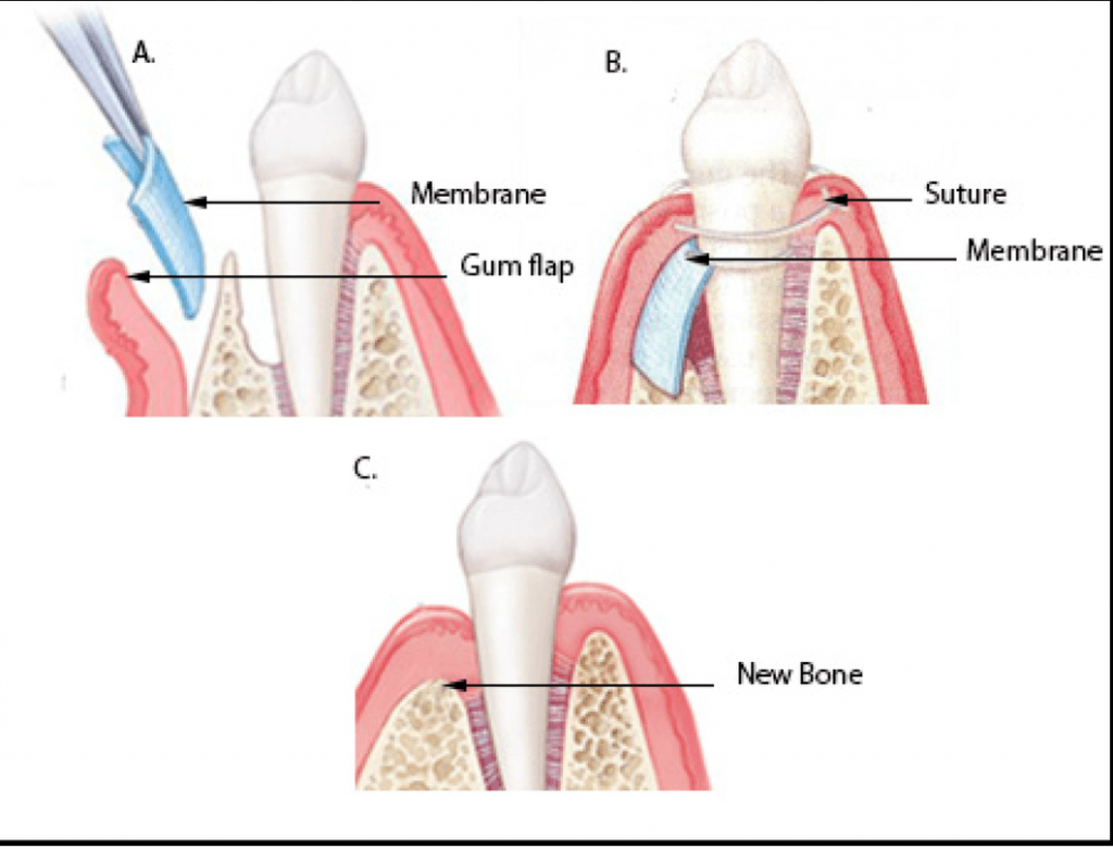 Regeneración tisular guiada - Clinica Oralmaxq