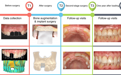 Técnicas de regeneración ósea dental : Cómo y cuándo recuperar hueso dental perdido