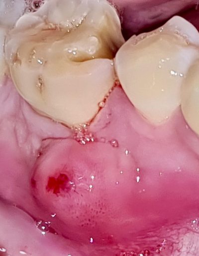 absceso-dental-en-queretaro-clinica-oralmaxq