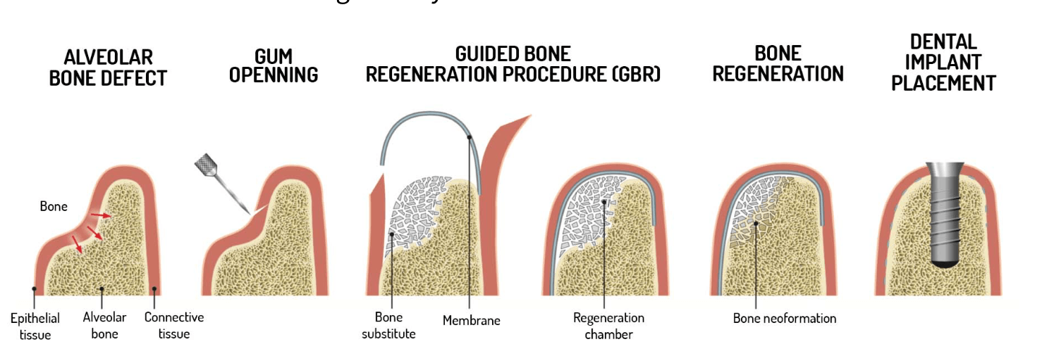 beneficios-de-la-regeneracion-osea-dental-clinica-oralmaxq