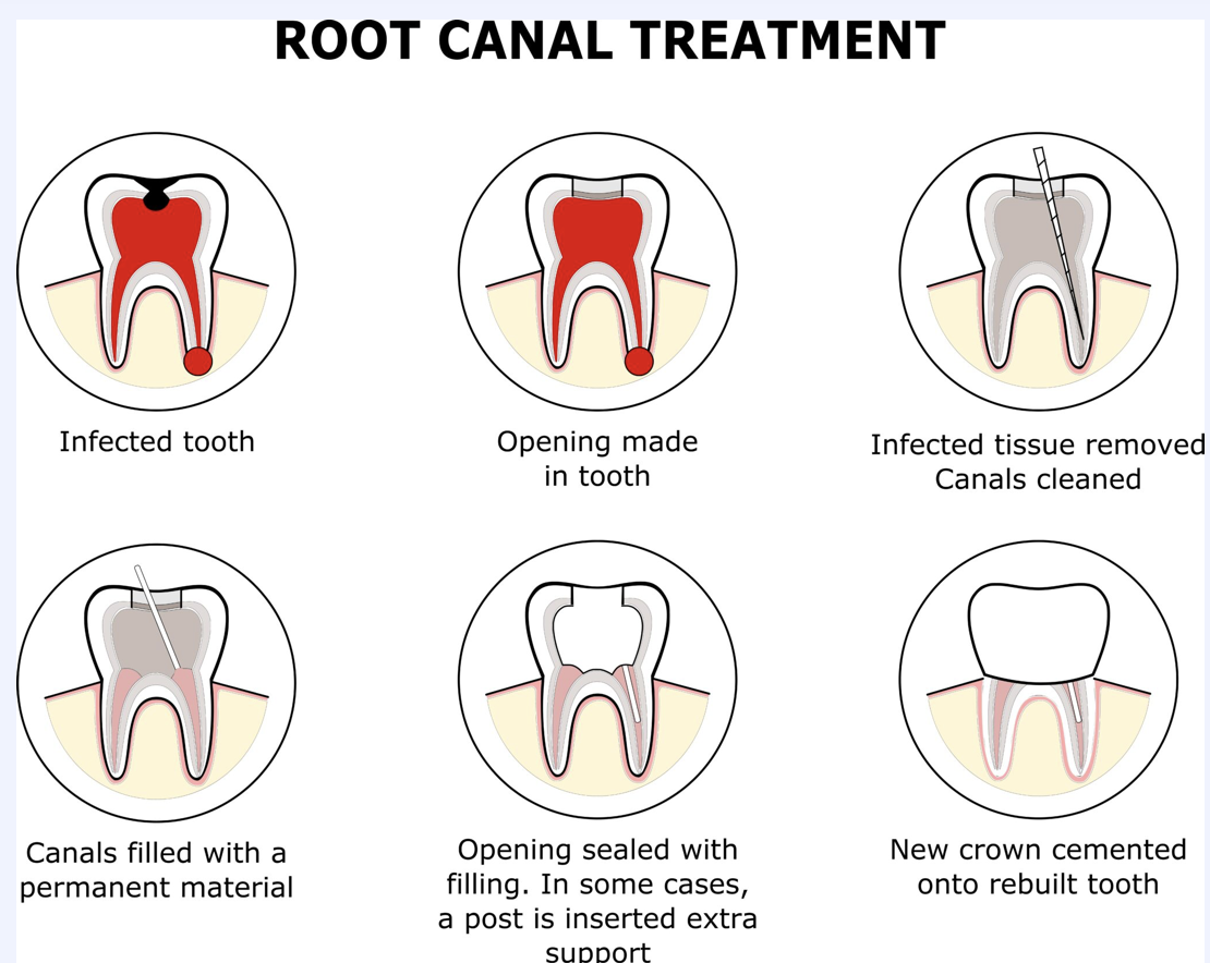 cuando-es-necesario-un-tratamiento-de-endodoncia-clinica-oralmaxq