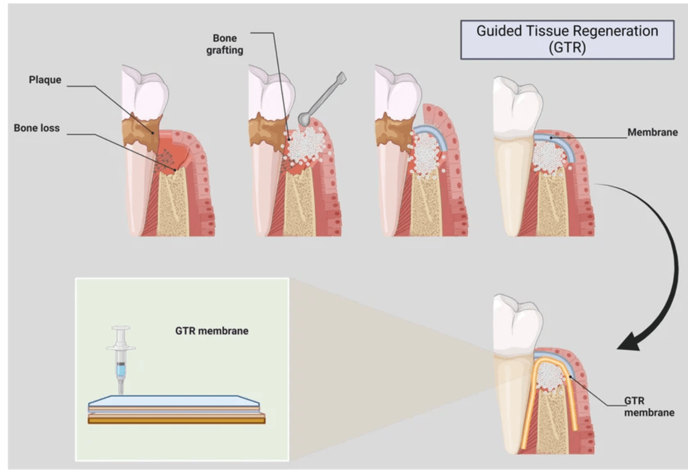 cuando-se-recomienda-la-regeneracion-osea-dental-clinica-oralmaxq