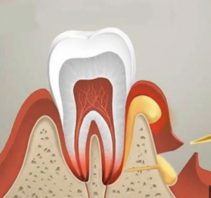drenaje-del-absceso-clinica-oralmaxq