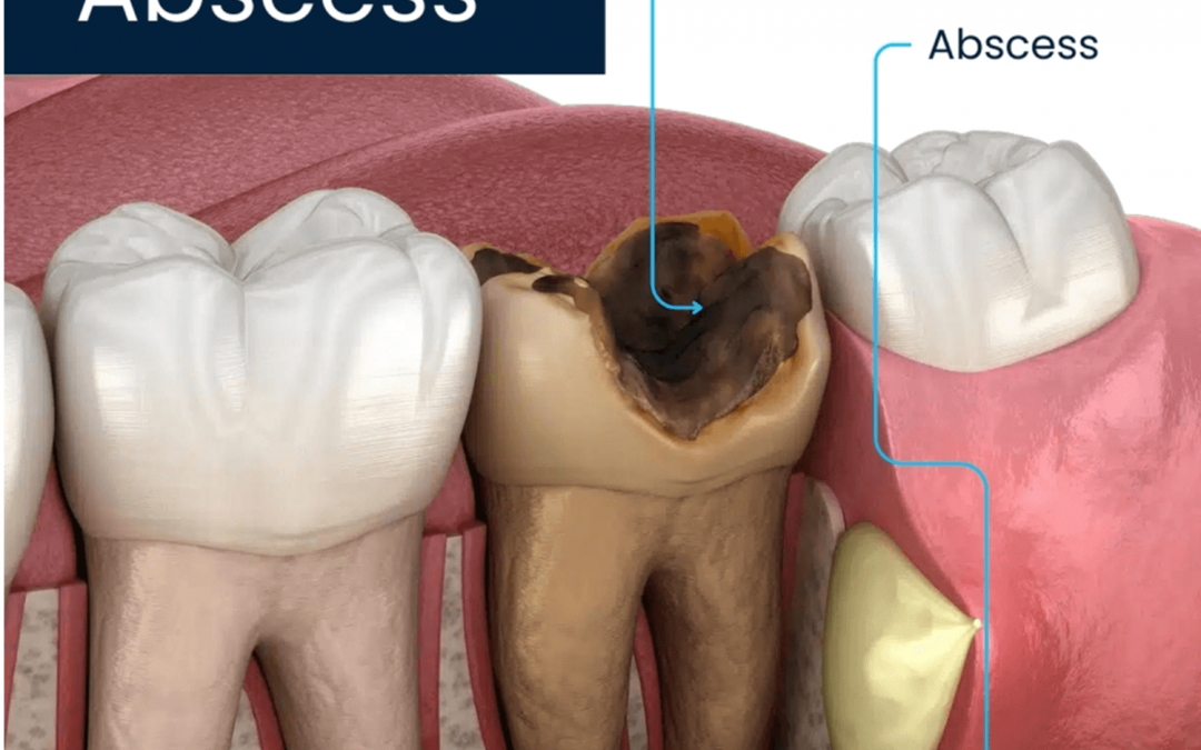drenaje-para-abscesos-dentales-clinica-oralmaxq