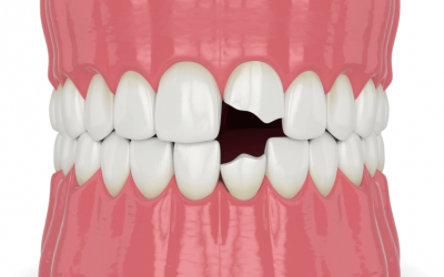 Fractura dental con exposición del nervio: síntomas y tratamiento inmediato
