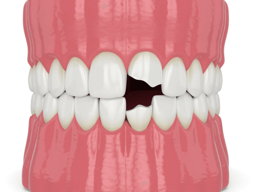 fractura-dental-con-exposición-del-nervio-clinica-oralmaxq