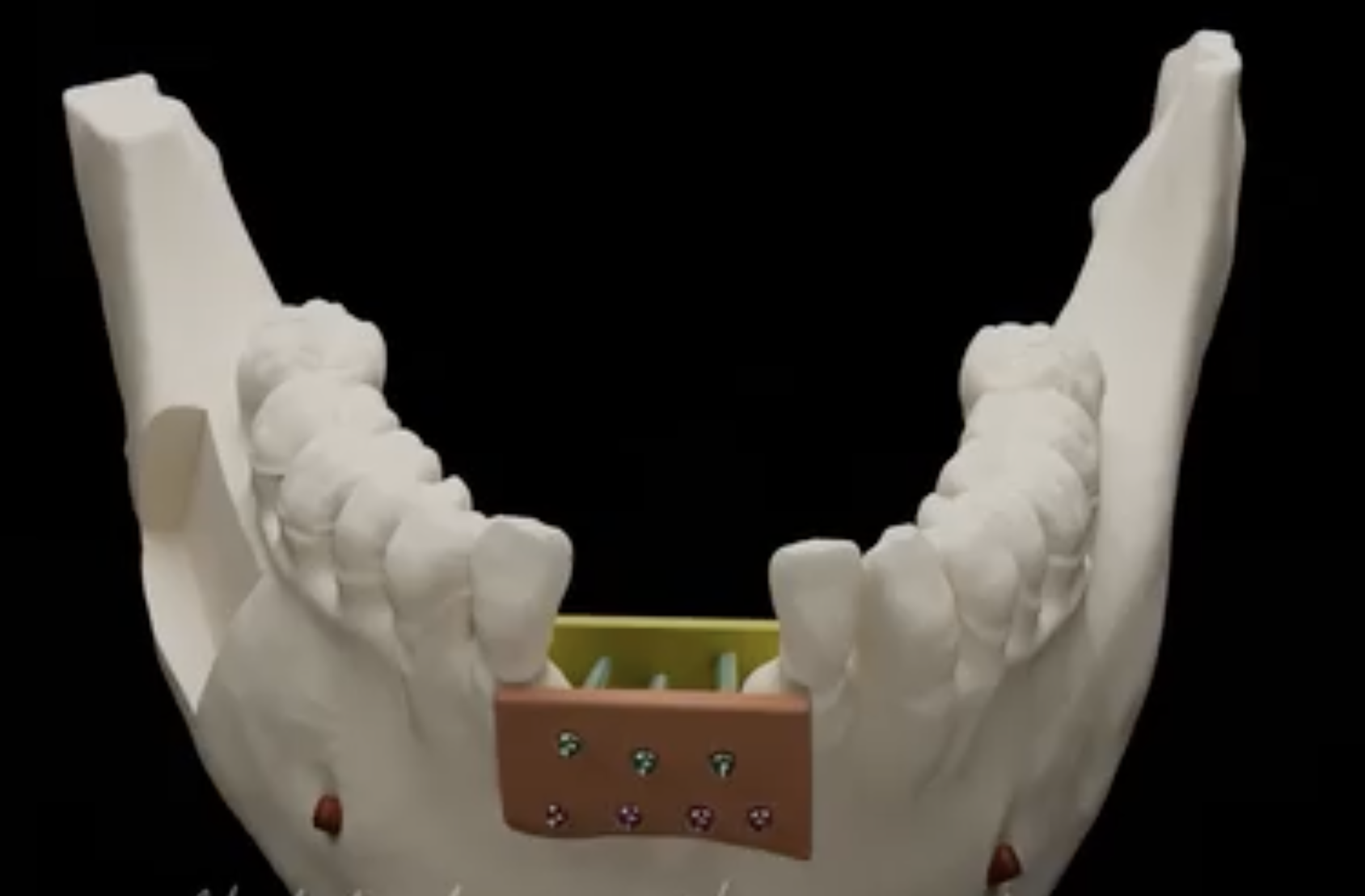 que-es-la-regeneracion-osea-dental-clinica-oralmaxq