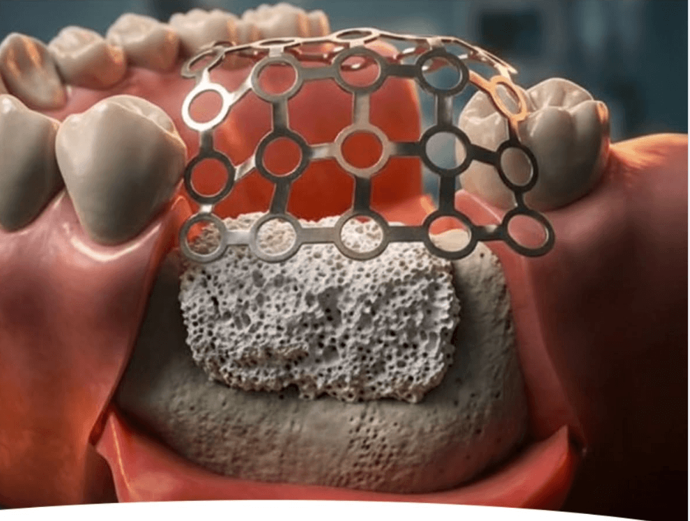 regeneracion-osea-dental-clinica-oralmaxq