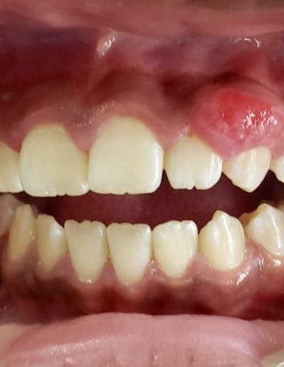 tratamiento-absceso-dental-clinica-oralmaxq