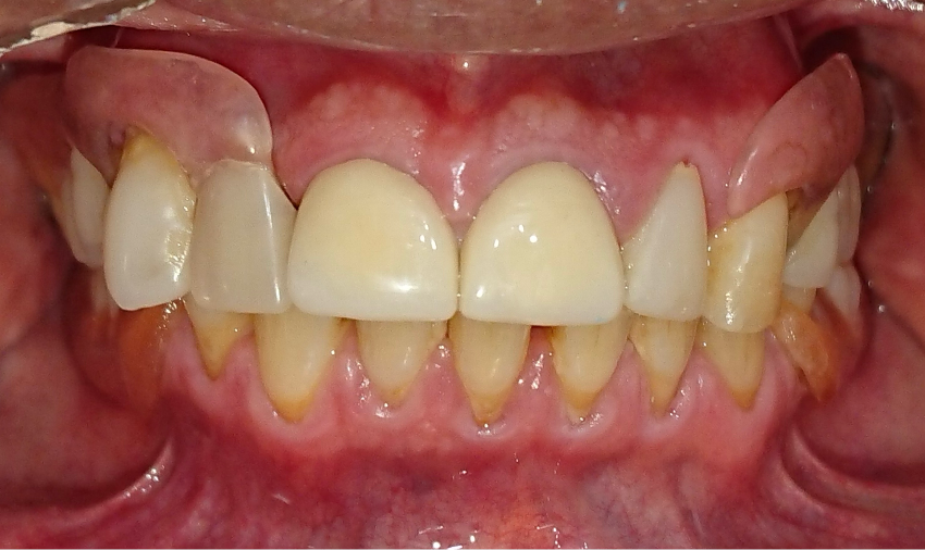 Estética de una prótesis dental