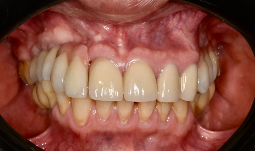 Funcionamiento de una prótesis dental