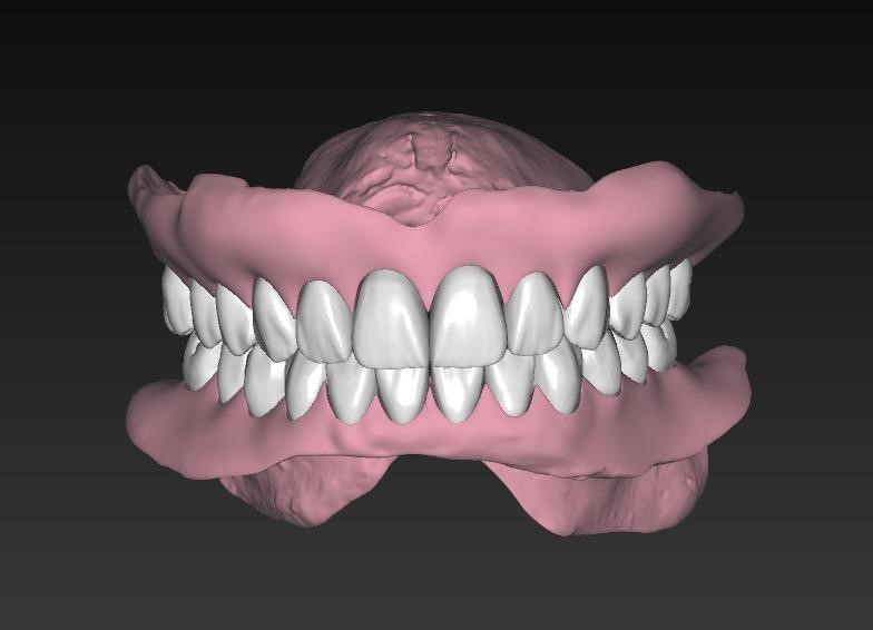 Prótesis Dentales