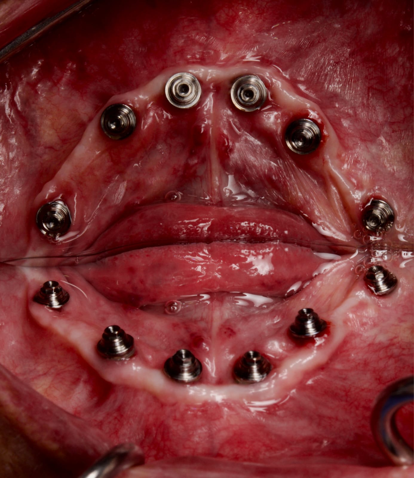 implantes-all-on-x-clinica-oralmaxq