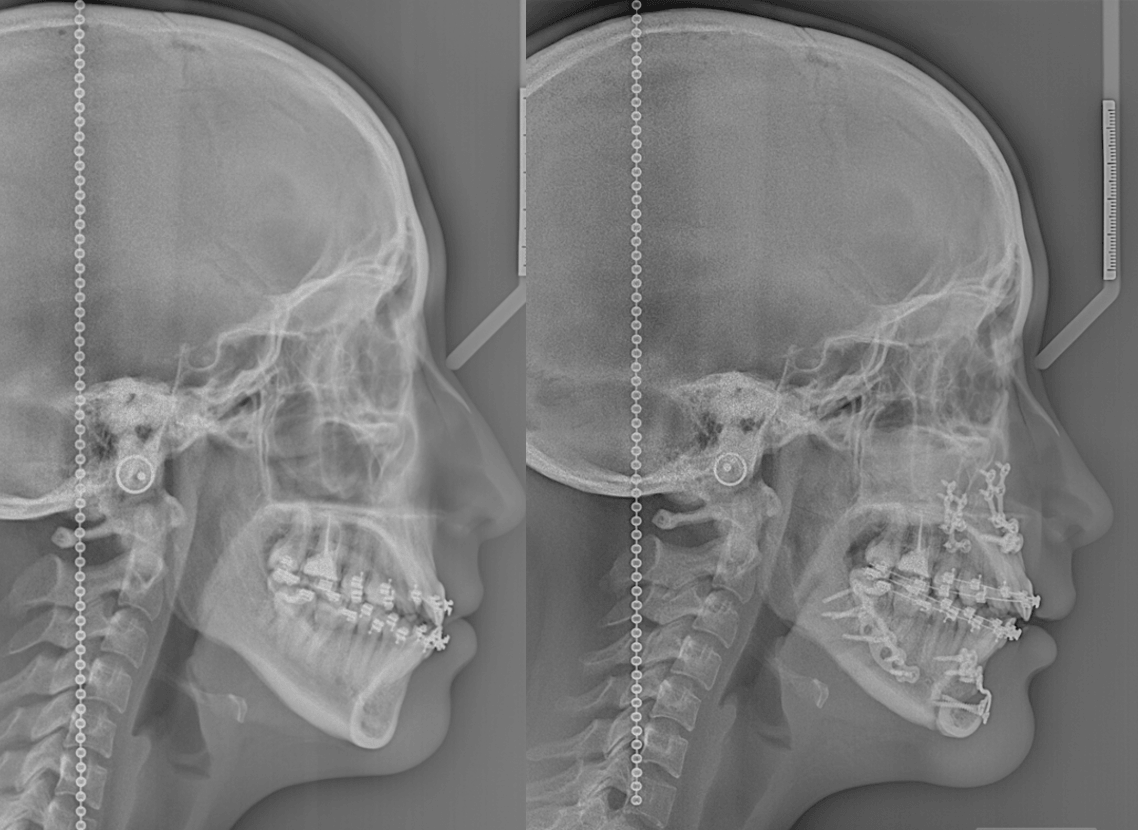 beneficios-de-la-cirugia-ortognatica-clinica-oralmaxq